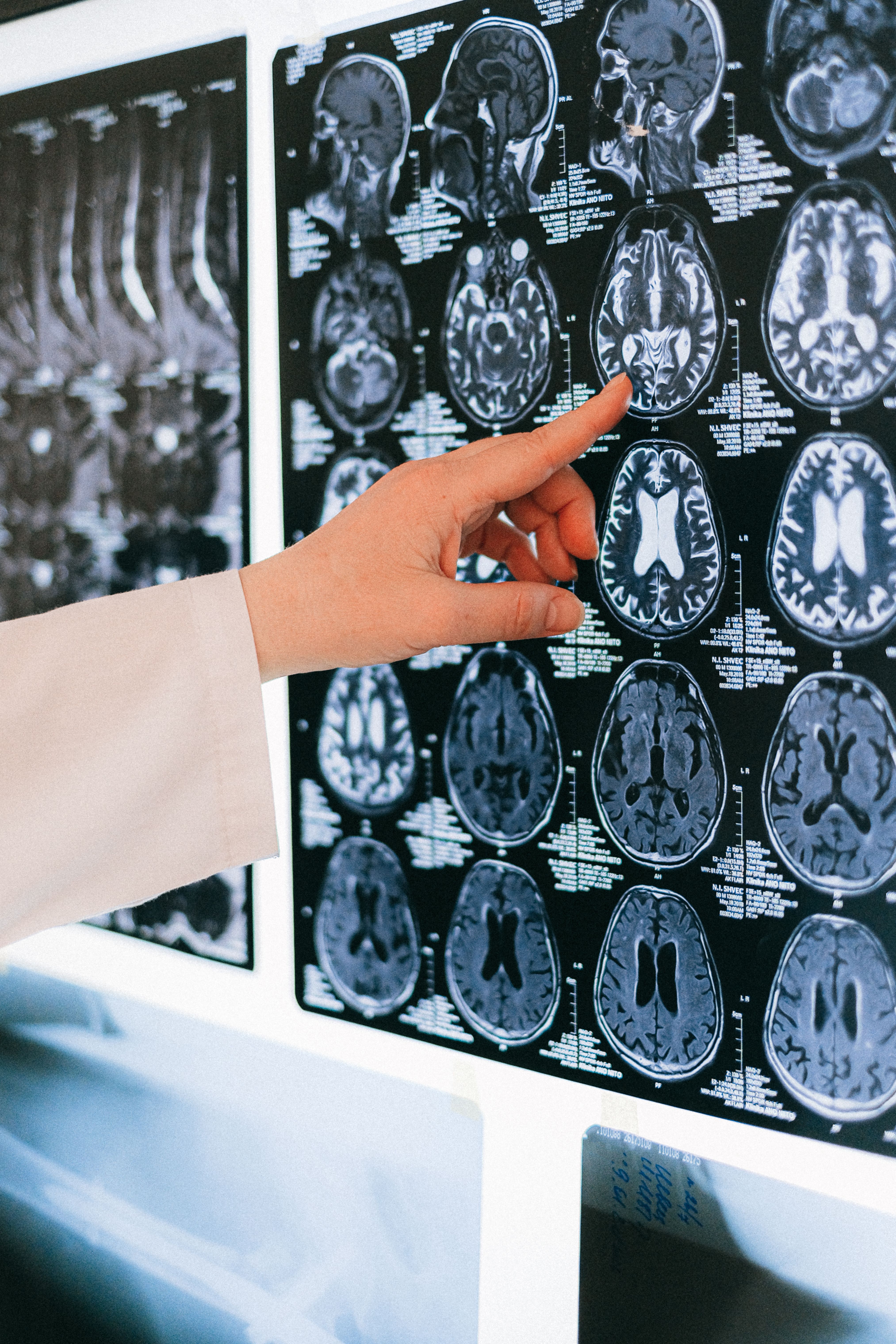 Cientista descobre "ponto de virada" que pode decidir quem desenvolve demência no alzheimer